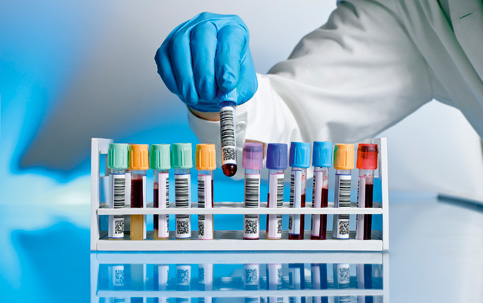 Cientistas estão mais perto de diagnosticar Alzheimer em teste de sangue
